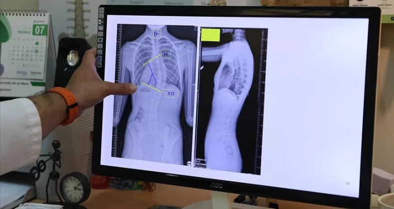 Çocuklarda ergenlik öncesi skolyoz kontrolü tedavi şansını artırıyor